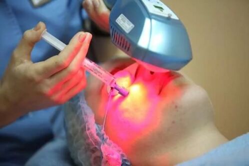 Biorevitalizarea cu laser a pielii feței