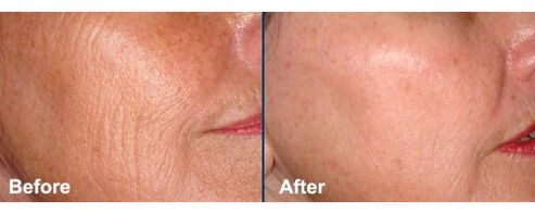 Pielea feței înainte și după procedura de întinerire cu laser