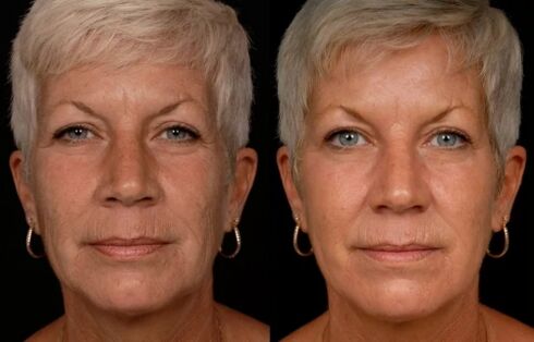 Rezultatul tratamentului cu laser a pielii feței - reducerea ridurilor